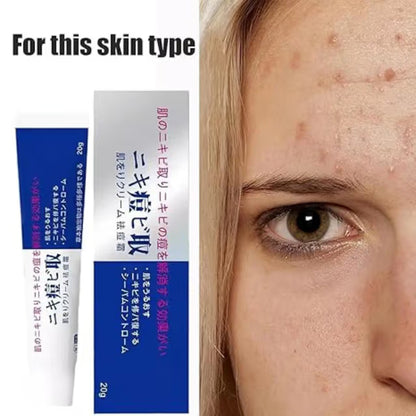Lion Pair Acne Cream 14ml, Japanese Formula for Pimples, Redness & Inflammation – Fast-Acting, Non-Irritating Spot Treatment